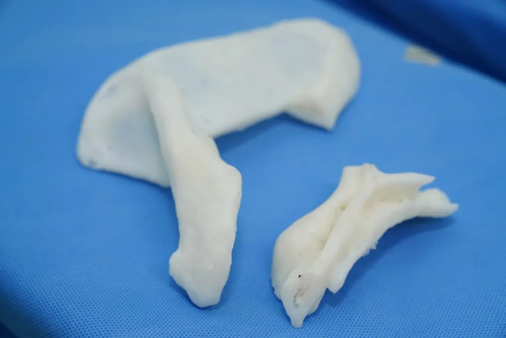 3D打印反肩置換，解決患者疑難復(fù)雜肩關(guān)節(jié)陳舊毀損傷難題